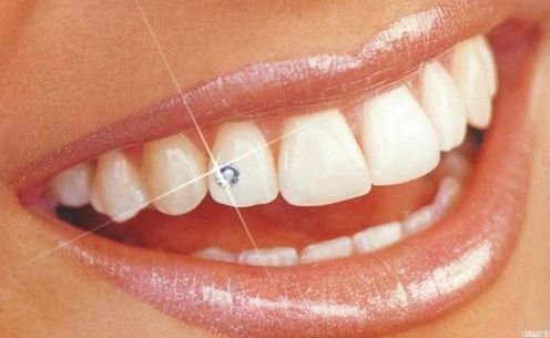 Украшение зубов: скайсы.