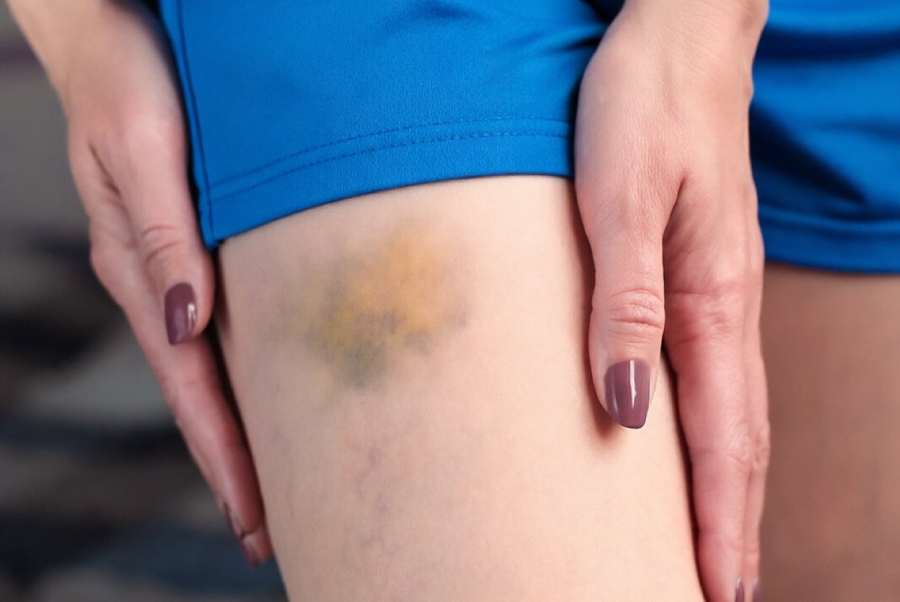 Вот почему синяки появляются без причины и как это исправить: три витамина для крепких сосудов